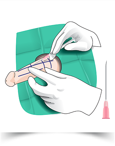 玻尿酸注射阴茎增粗手术怎么做效果如何