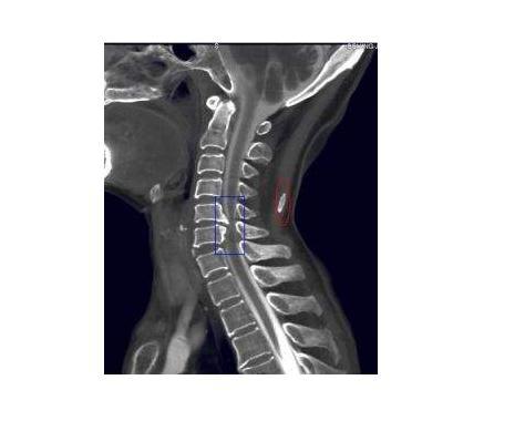 颈椎轻度骨质增生