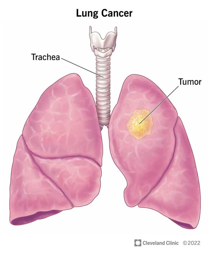 lung-cancer