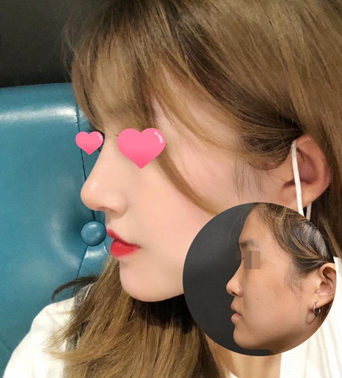 angelababy 新剧鼻子又透光,就是隆鼻了吗?看完我的分析就明白了!