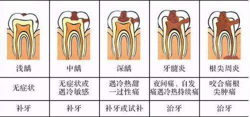 根管治疗疼吗大概要多少钱