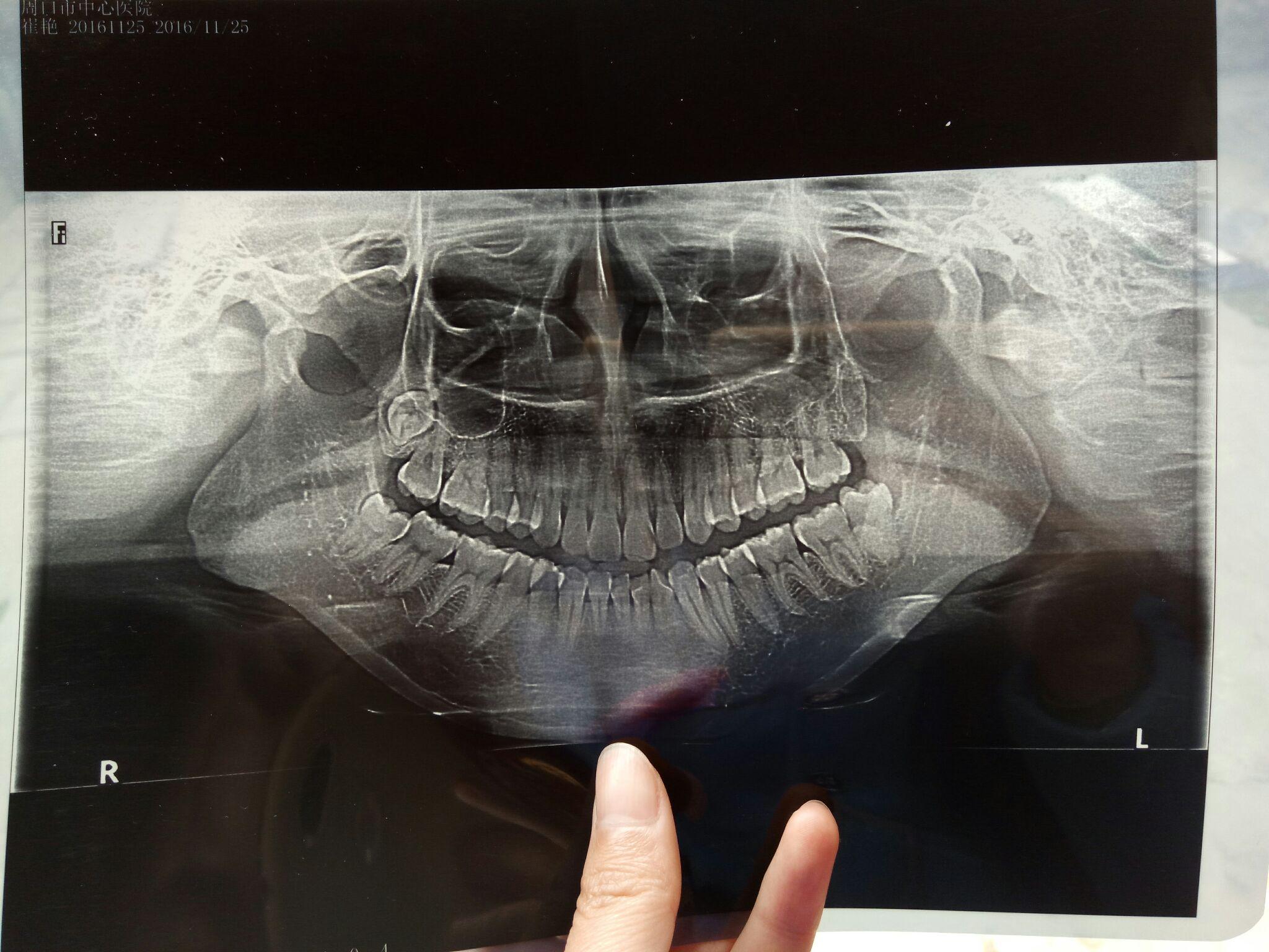 颞下颌关节紊乱症会导致左右脸不对称吗?