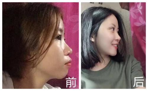 记录我带牙套112个月变化图朋友见了都说我整容了