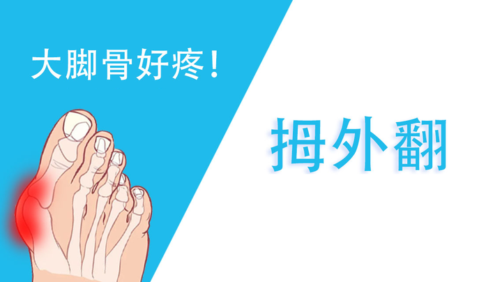 郝雨生解说,缓解大脚骨疼痛方法? - 知乎