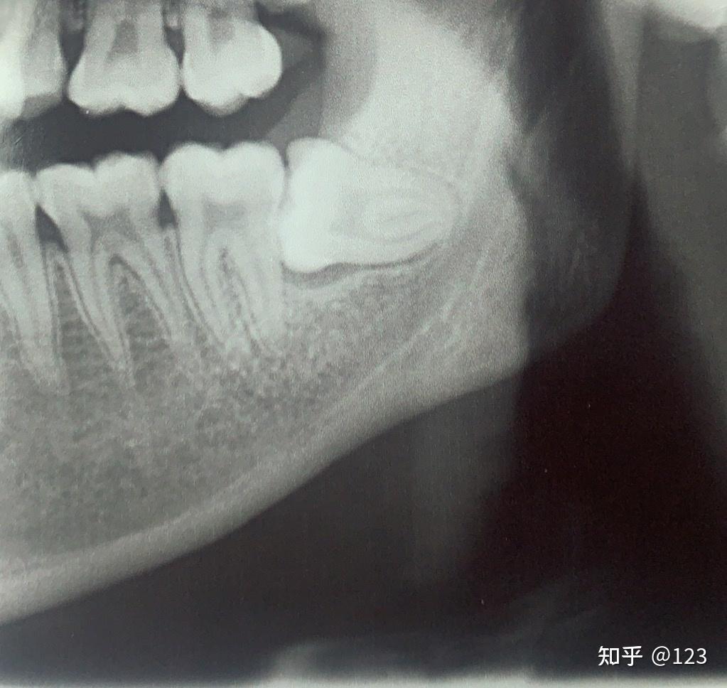 水平下颌低位阻生智齿,不疼,能不拔吗? - 知乎