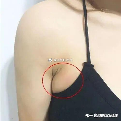 "副乳"是指人体除了正常的一对乳房之外出现的多余乳房,一般在腋前