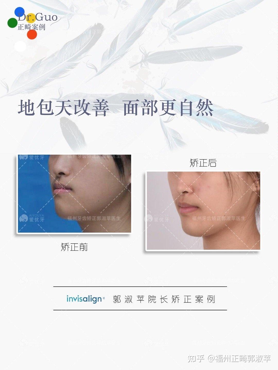 福州牙齿矫正|地包天患者必看:如何“拉”回你的下巴 - 知乎