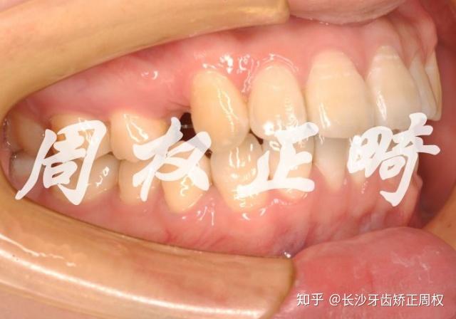 长沙牙齿矫正之舌侧隐形矫正龅牙案例-完整版 - 知乎