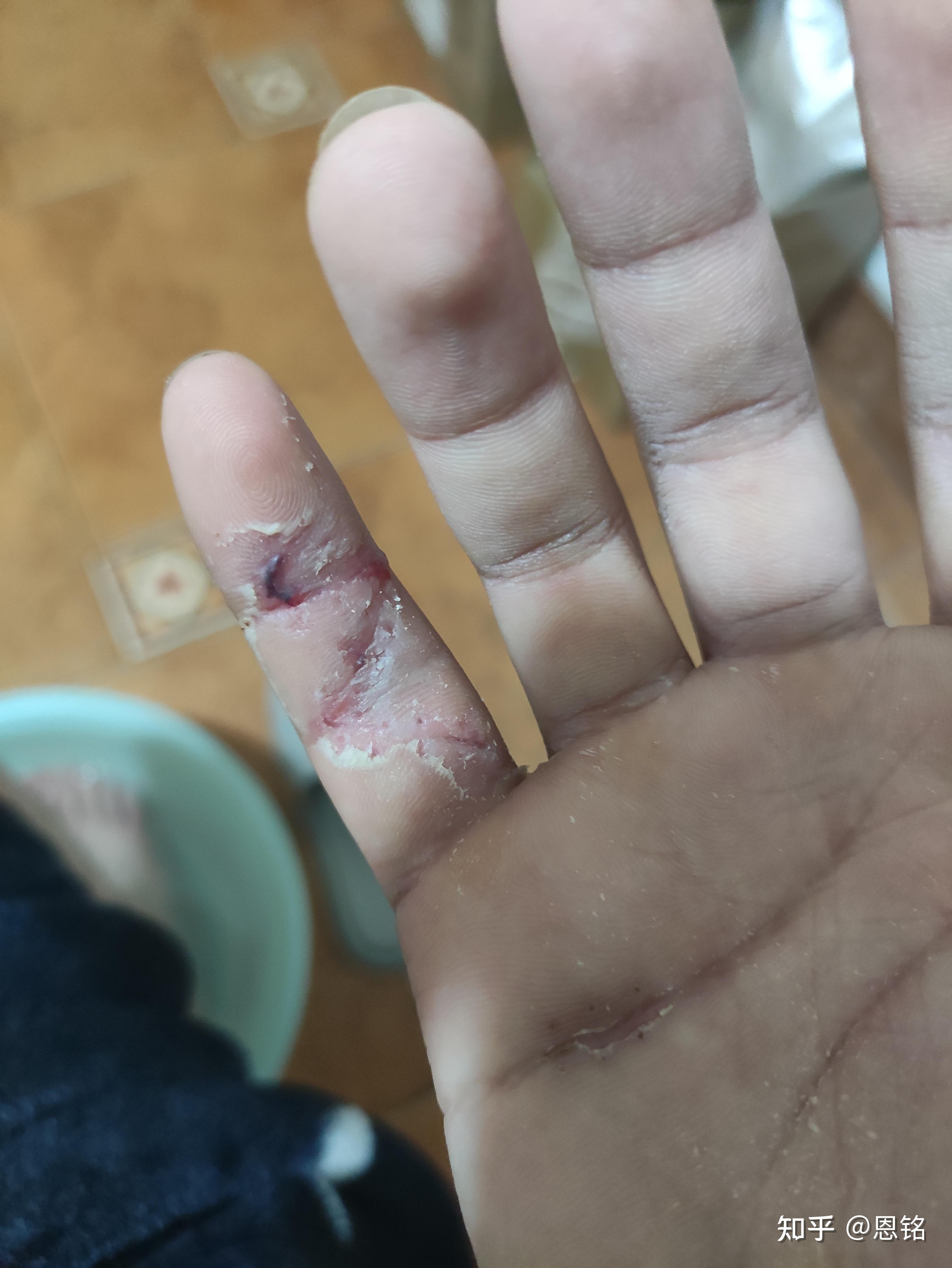 手指肌腱断裂最后一节无法伸直医生教我不要治疗了请