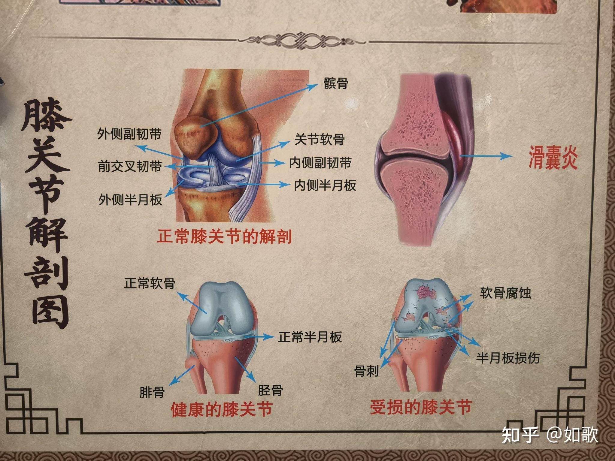 半月板损伤自我判断图图片