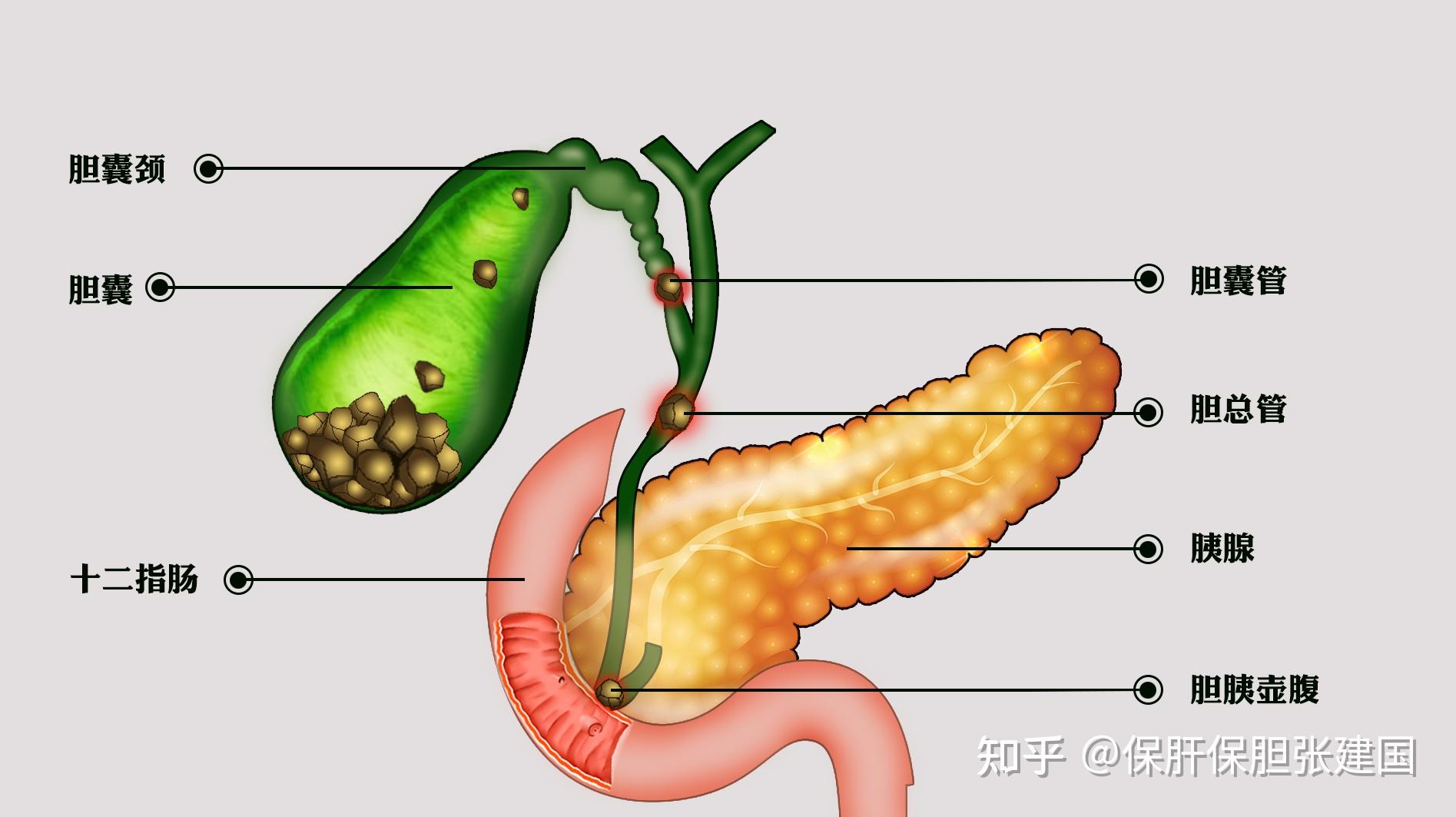 胆囊结石有哪些表现致病原因是什么该如何预防和治疗呢