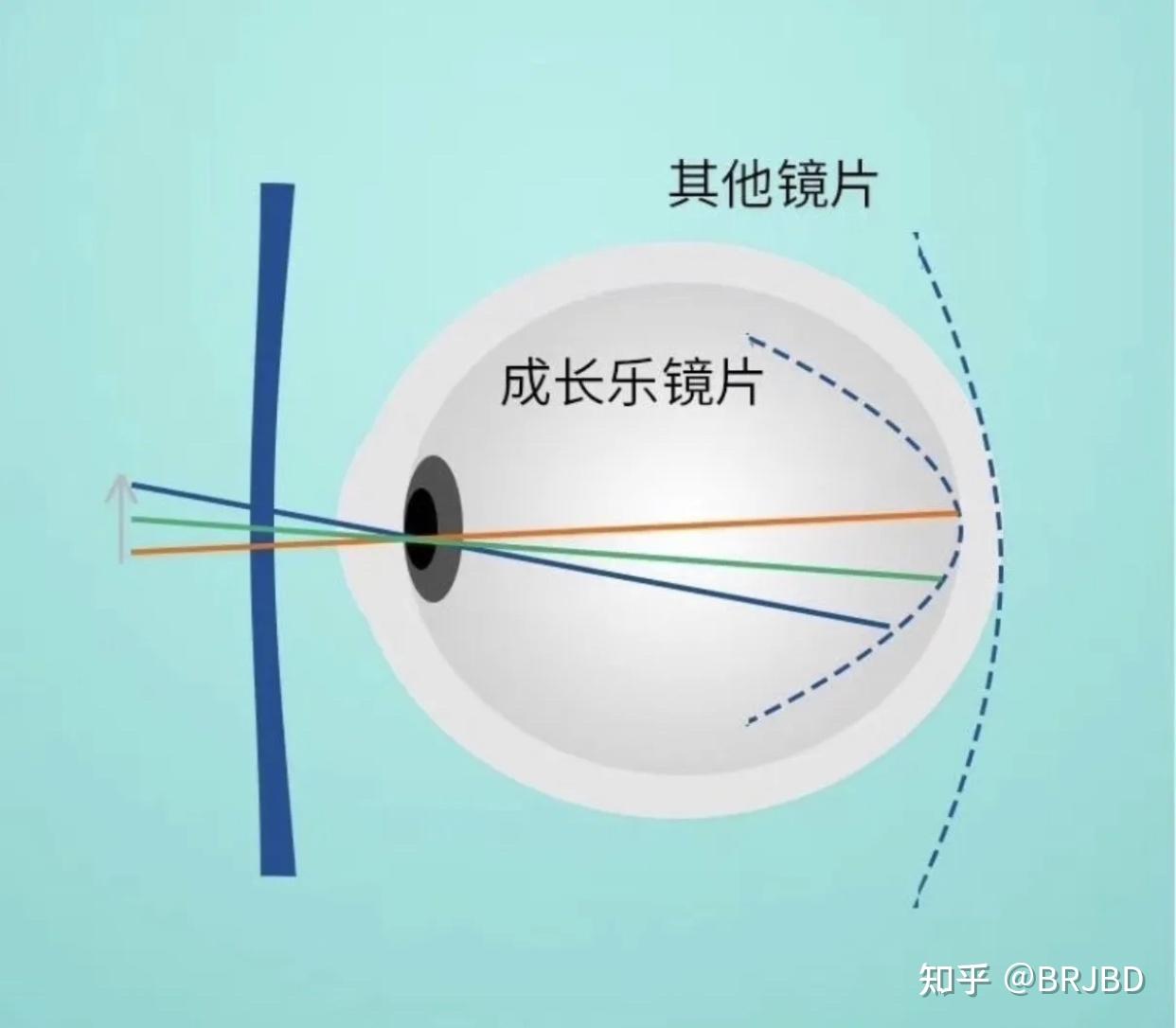 成长乐镜片原理图片