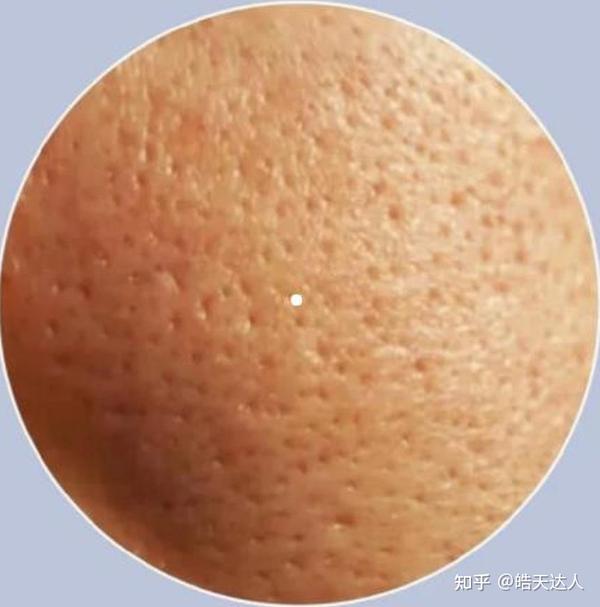 毛孔粗大怎么办?四大毛孔类型,你是哪一种 - 知乎
