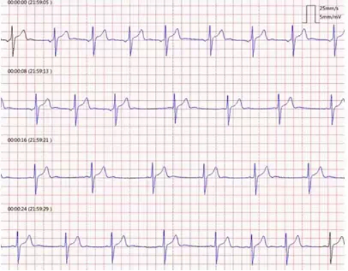 不同情绪的心电图图片