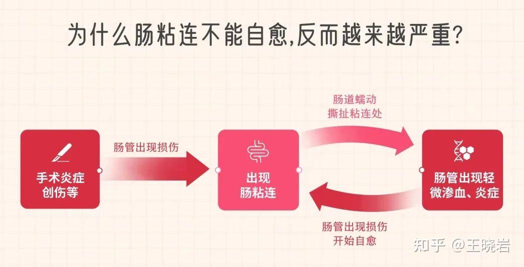 肠粘连患者掌握这10个问题就能轻松摆脱肠粘连 - 知乎