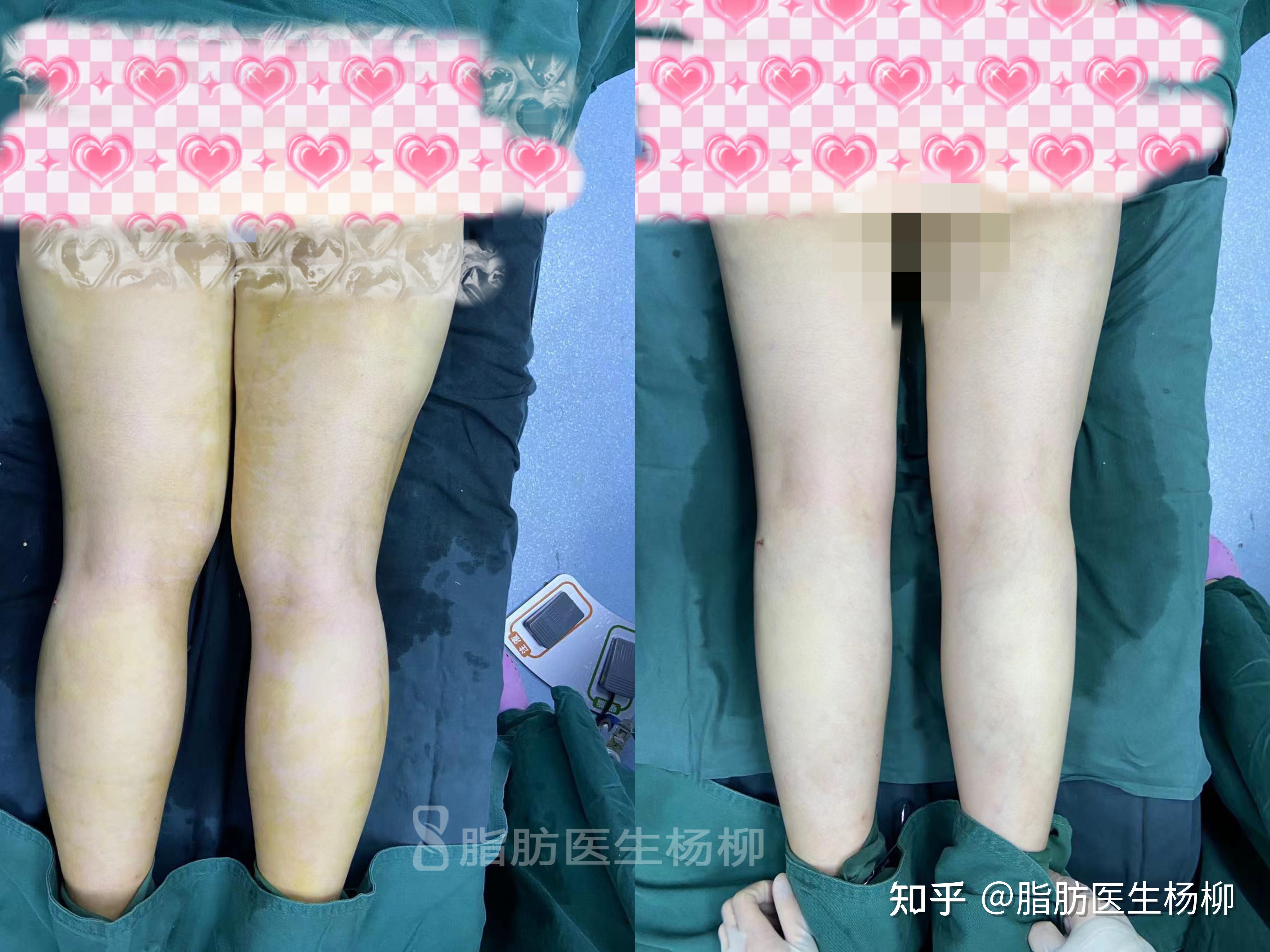 小腿抽脂-打造穠纖合度完美小腿 - 周爾康整形外科診所