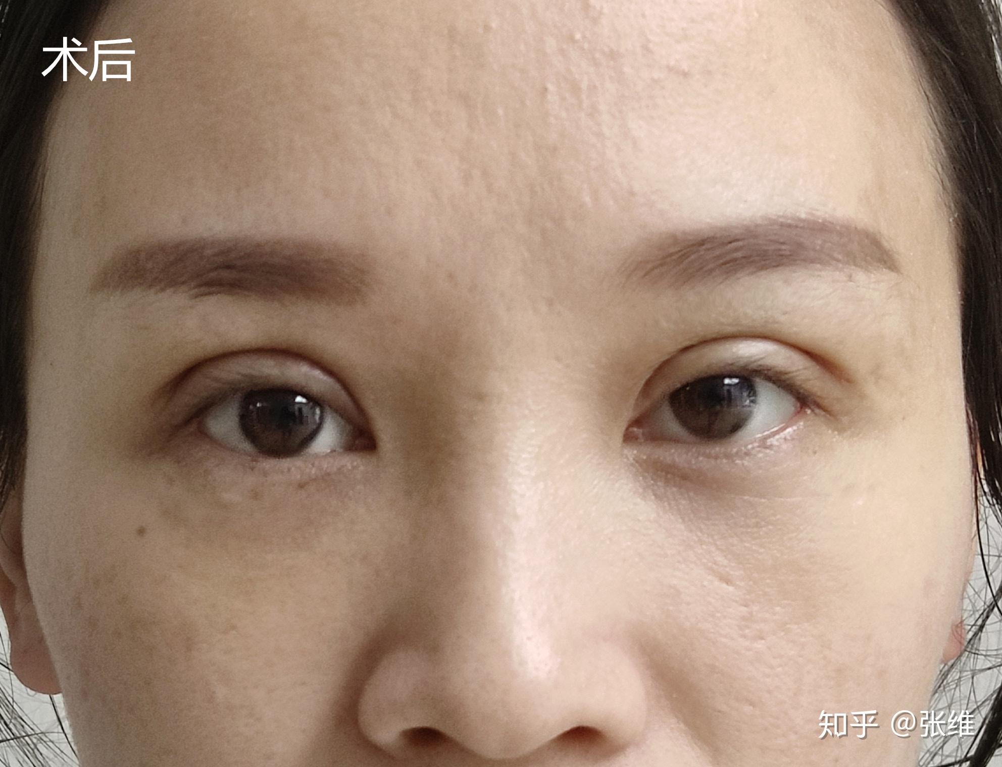 有双眼皮还能再做双眼皮吗? - 知乎