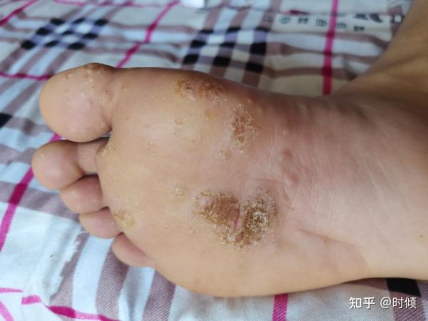 史上最严重跖疣治疗过程,试过七八种办法带你从根源上了解跖疣(有图胆小勿入) - 知乎