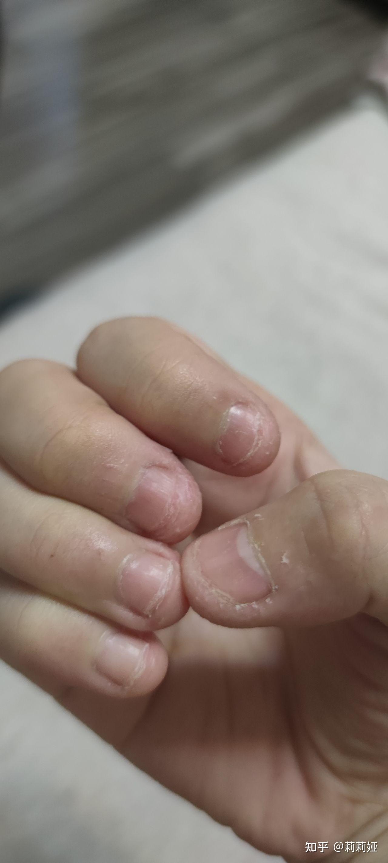 我今天26了,从小就爱咬指甲,试了很多方法都改不掉.是心理疾病吗.