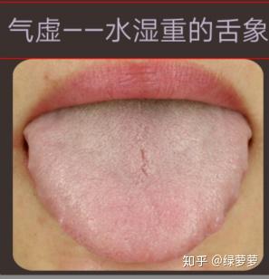 气虚体质---水湿重人的舌象 - 知乎