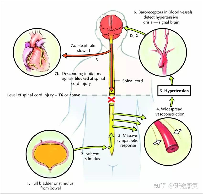 脊髓自主反射图片