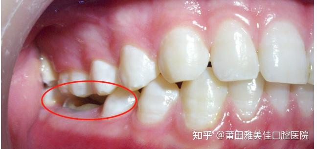 莆田口腔解密||什么是牙齿残冠?修复一次多少钱? - 知乎