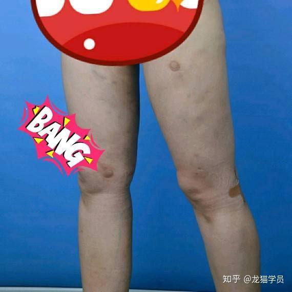 说实在的大腿抽脂到底会不会凹凸不平坑坑洼洼