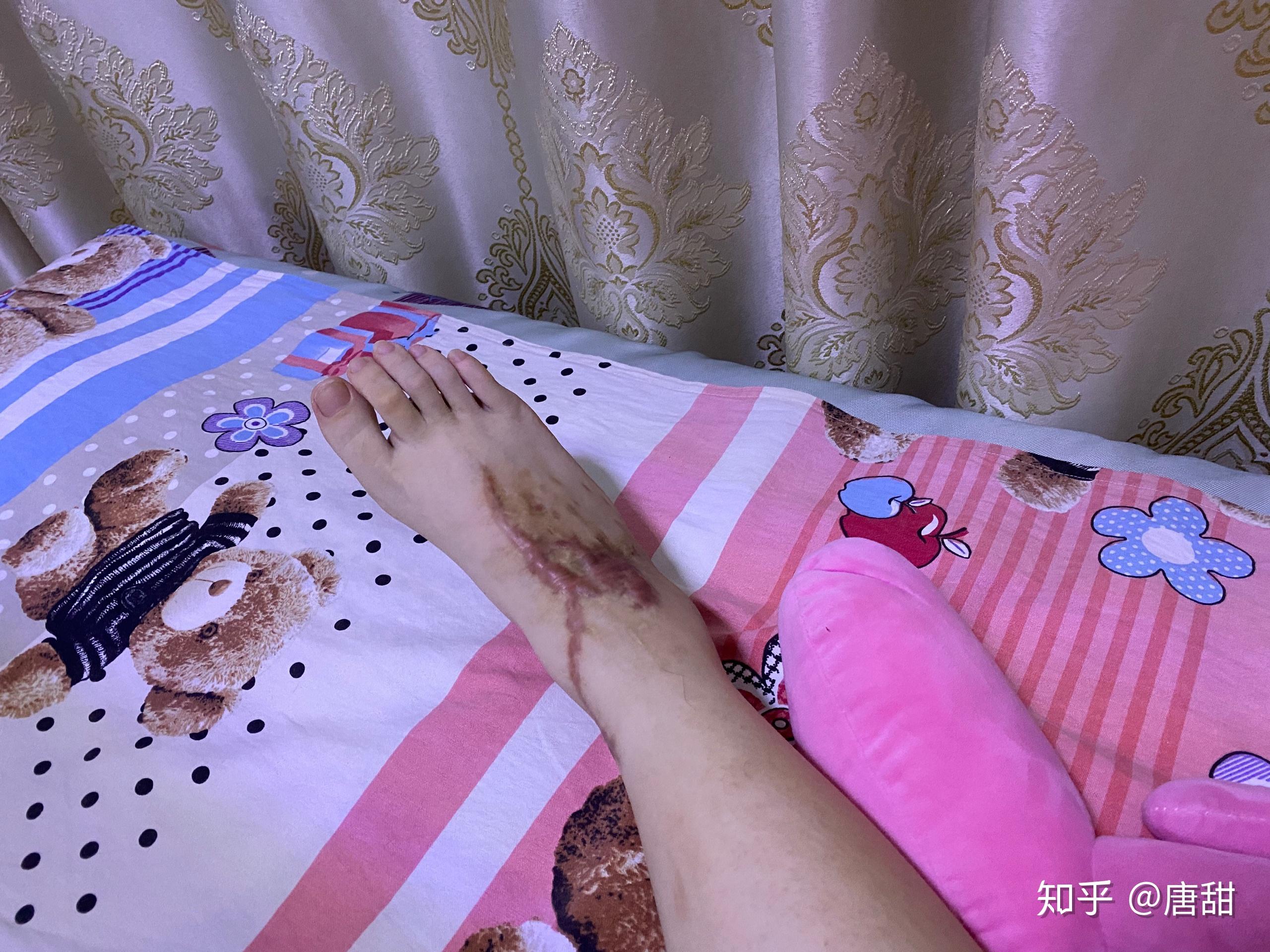 脚踝距腓前韧带断裂的经历