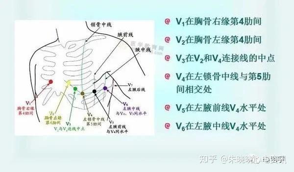 当电极位置升高2cm时,r波振幅明显降低,rs型波可能变为qs型,有可能被