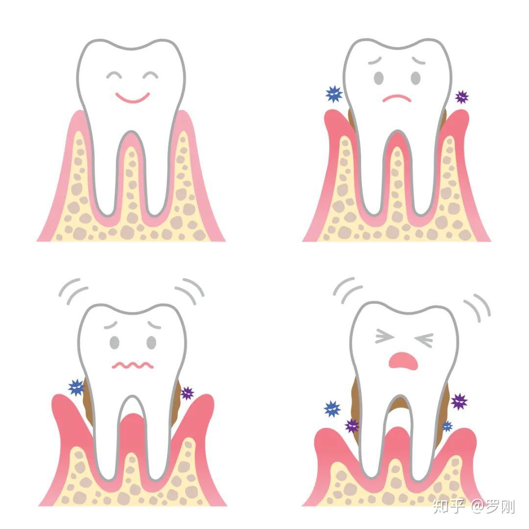 牙石最简单的清除方式是什么（"牙结石"可以自己抠掉吗？教你一招，牙缝的脏东西或能轻松掉） | 说明书网