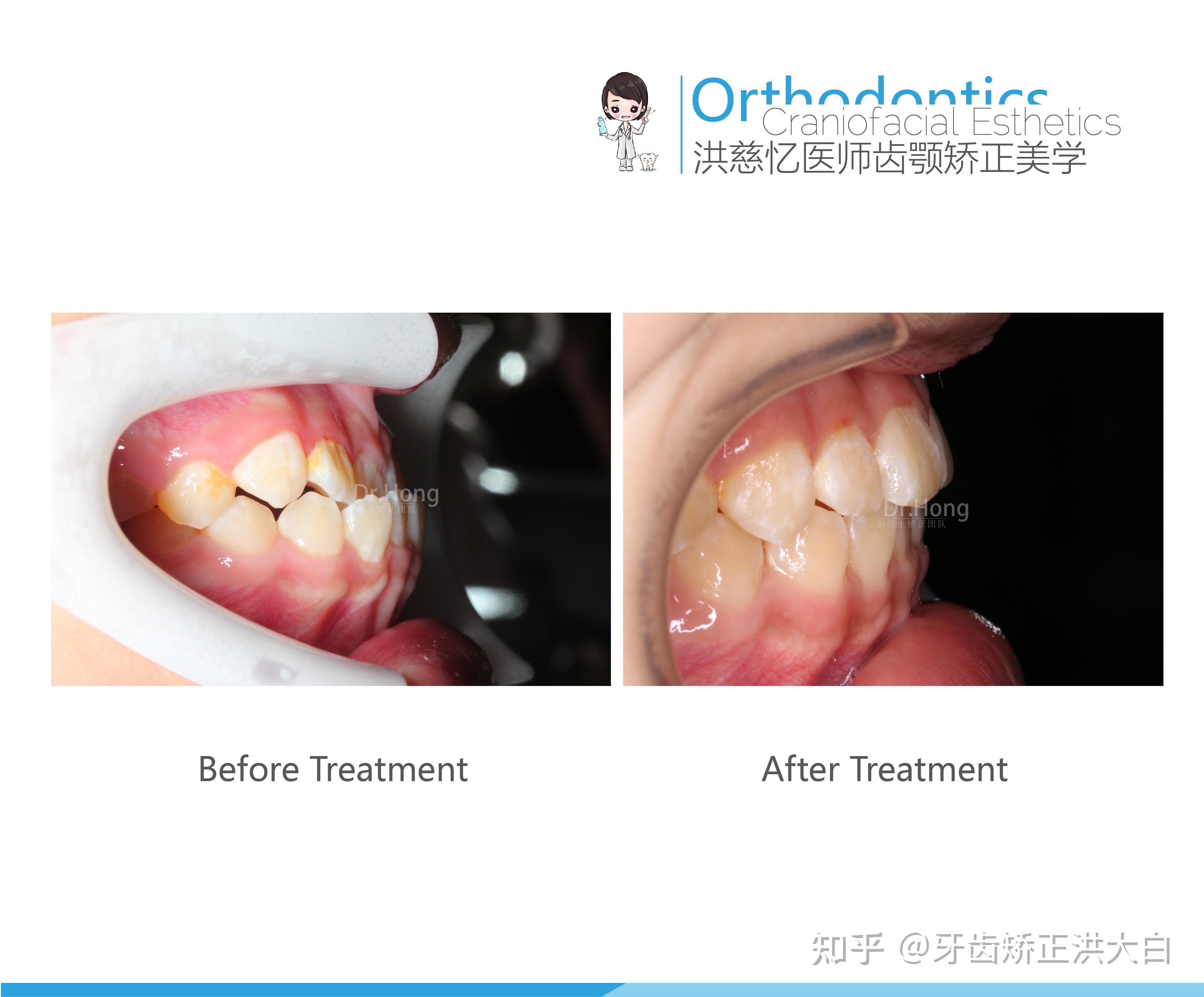 牙齿矫正对比照侧面图片