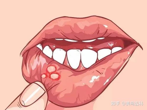 二、口腔溃疡的临床表现