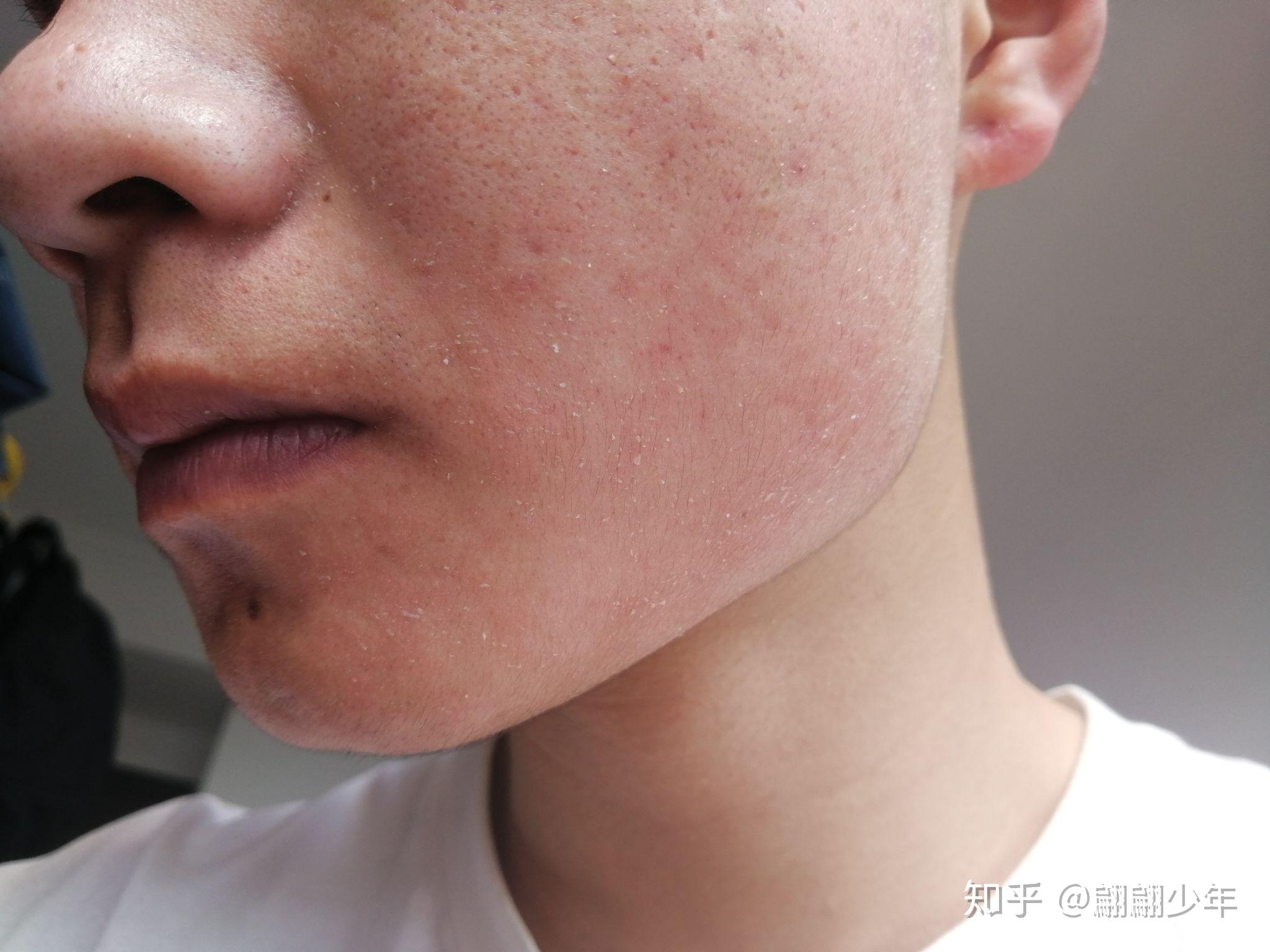 阿达帕林凝胶灼烧蜕皮? - 知乎