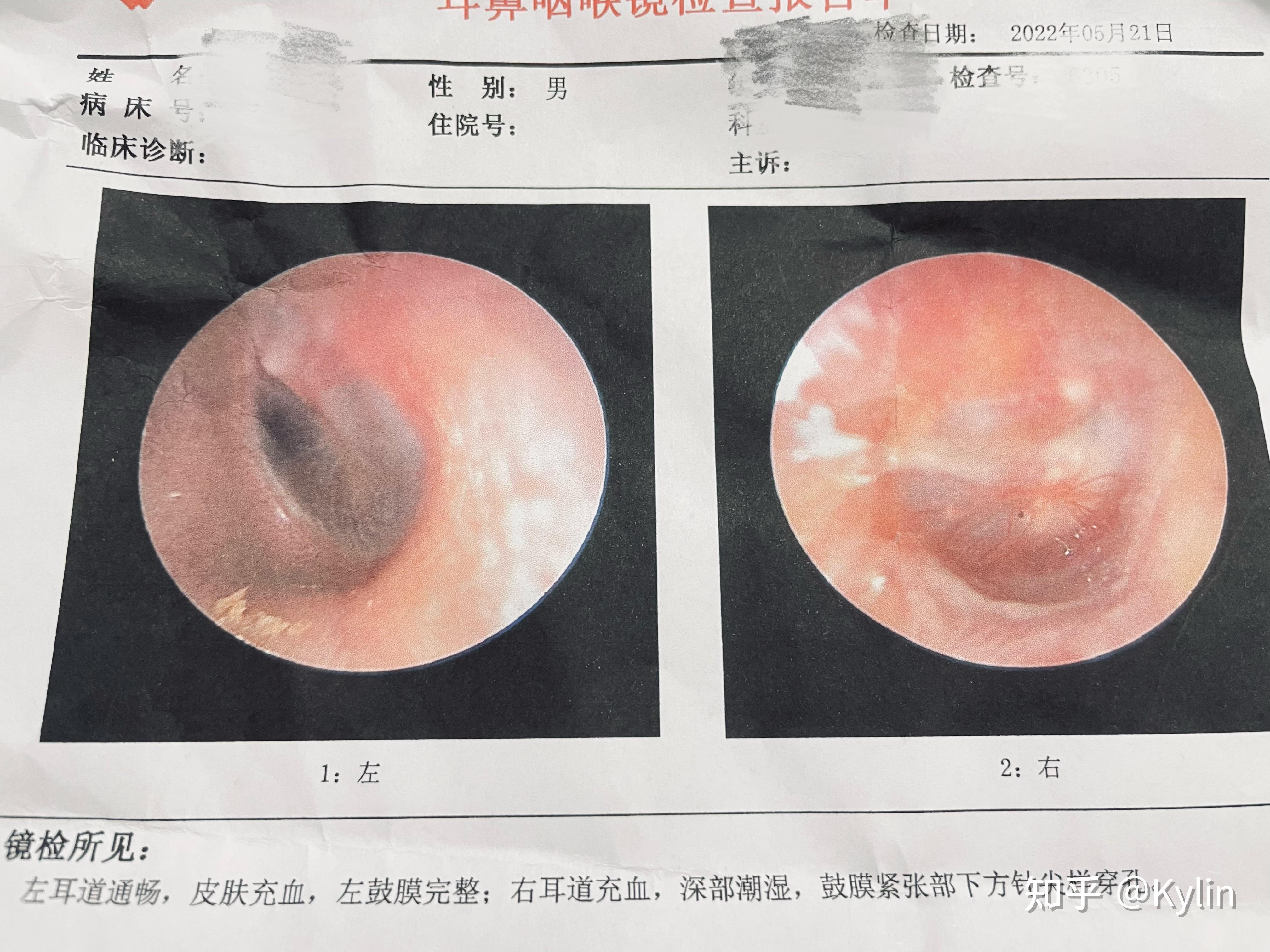 耳膜穿孔修復手術全過程記錄第五天出院了20220611更新已康復