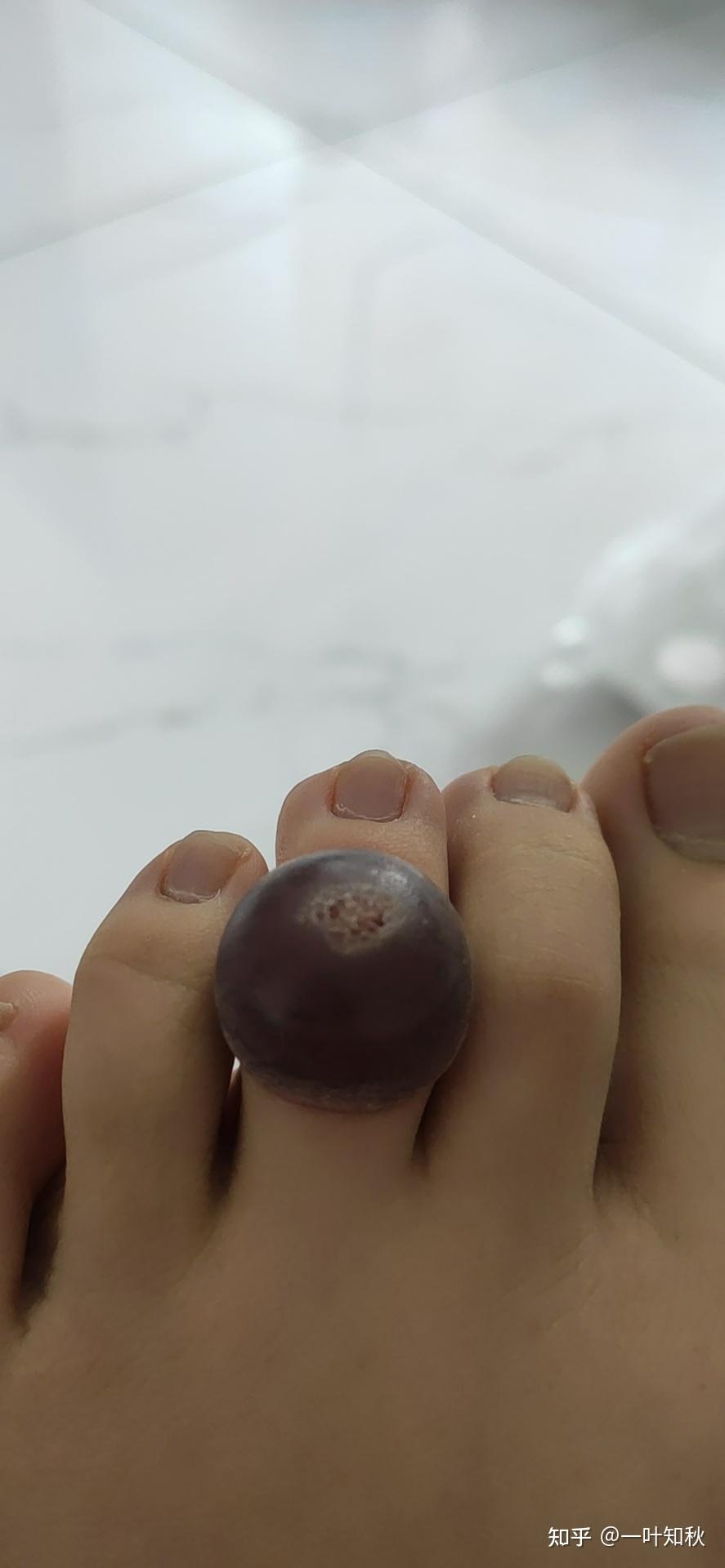 液氮冷冻治疗后手指上出了血泡而且越来越大该怎么办