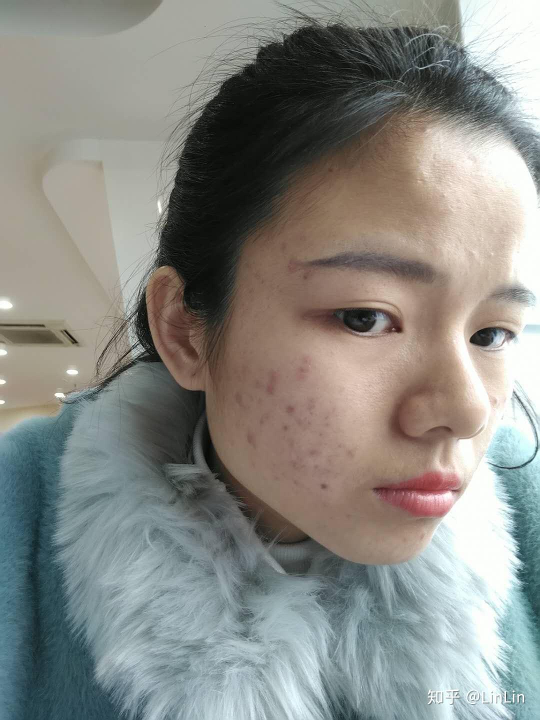 谁说挑痘挑粉刺没用的我就是去美容店挑粉刺挑痘痘变美的最后把自己