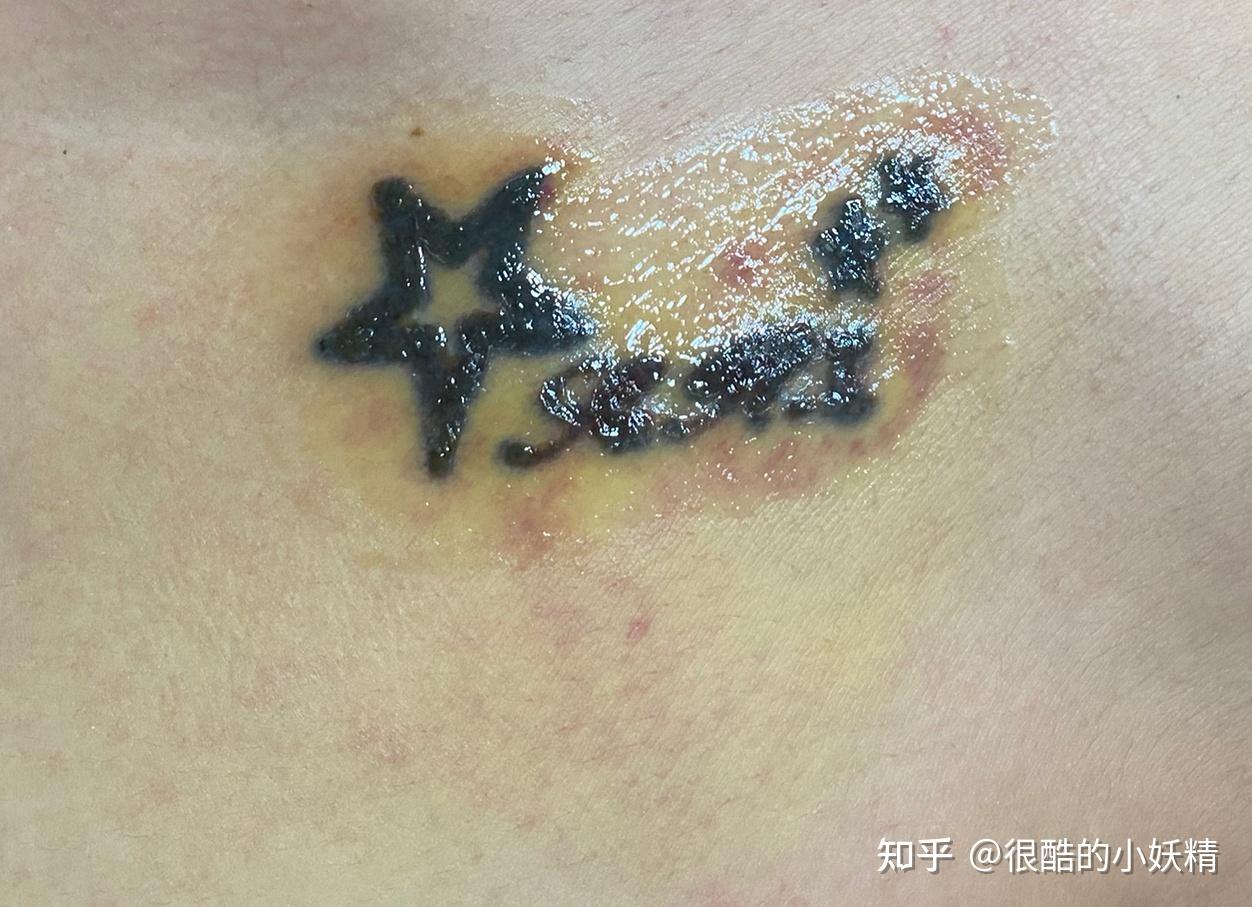 8815第三个晚上,可以很清晰看到小水泡扁了,周边的红淤有些变了黄