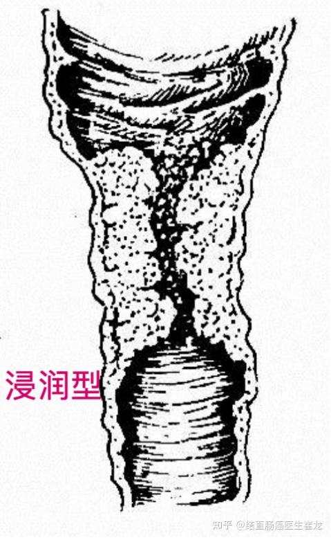 直肠腺癌病理绘图图片