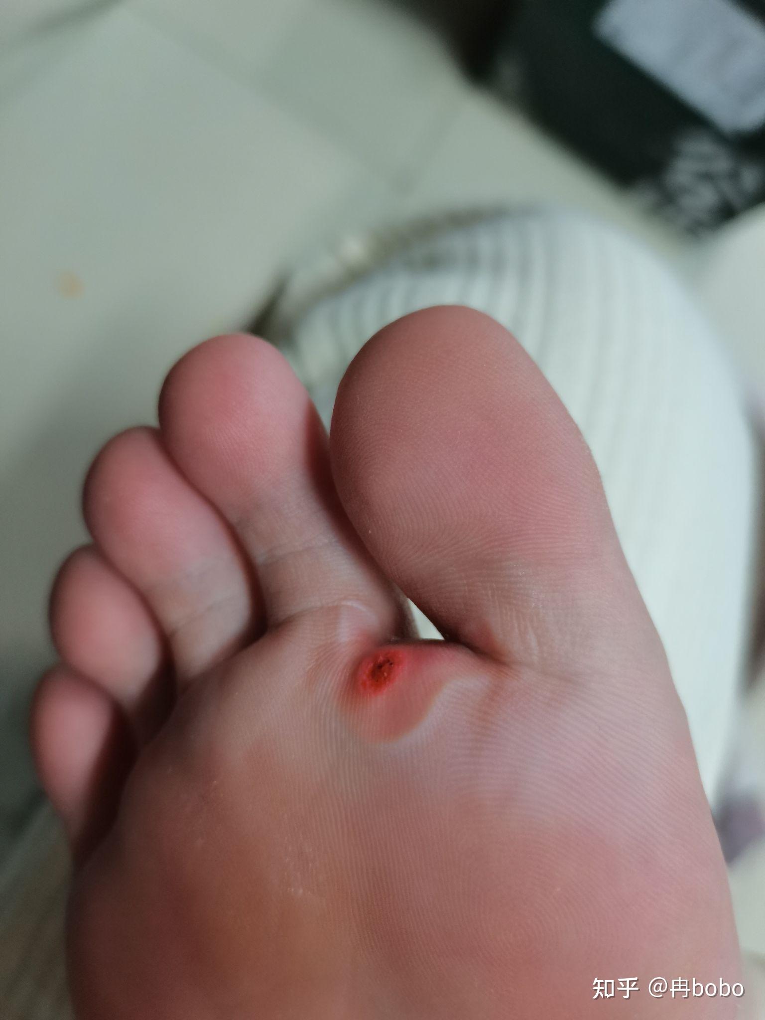 室友挖鸡眼是一种怎样的体验? - 知乎