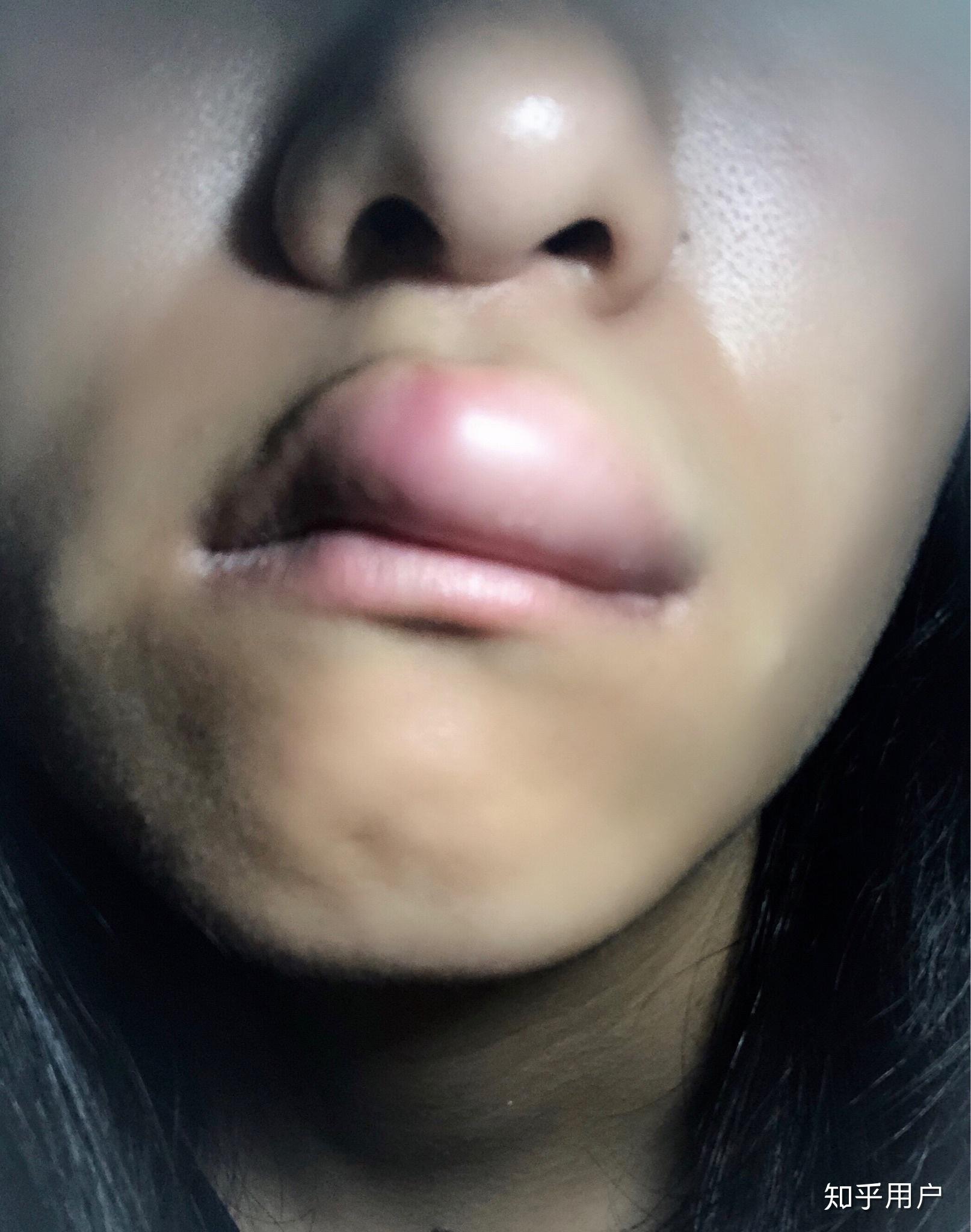 嘴唇被蚊子了!然后肿了一个很大的包!怎么办! - 知乎