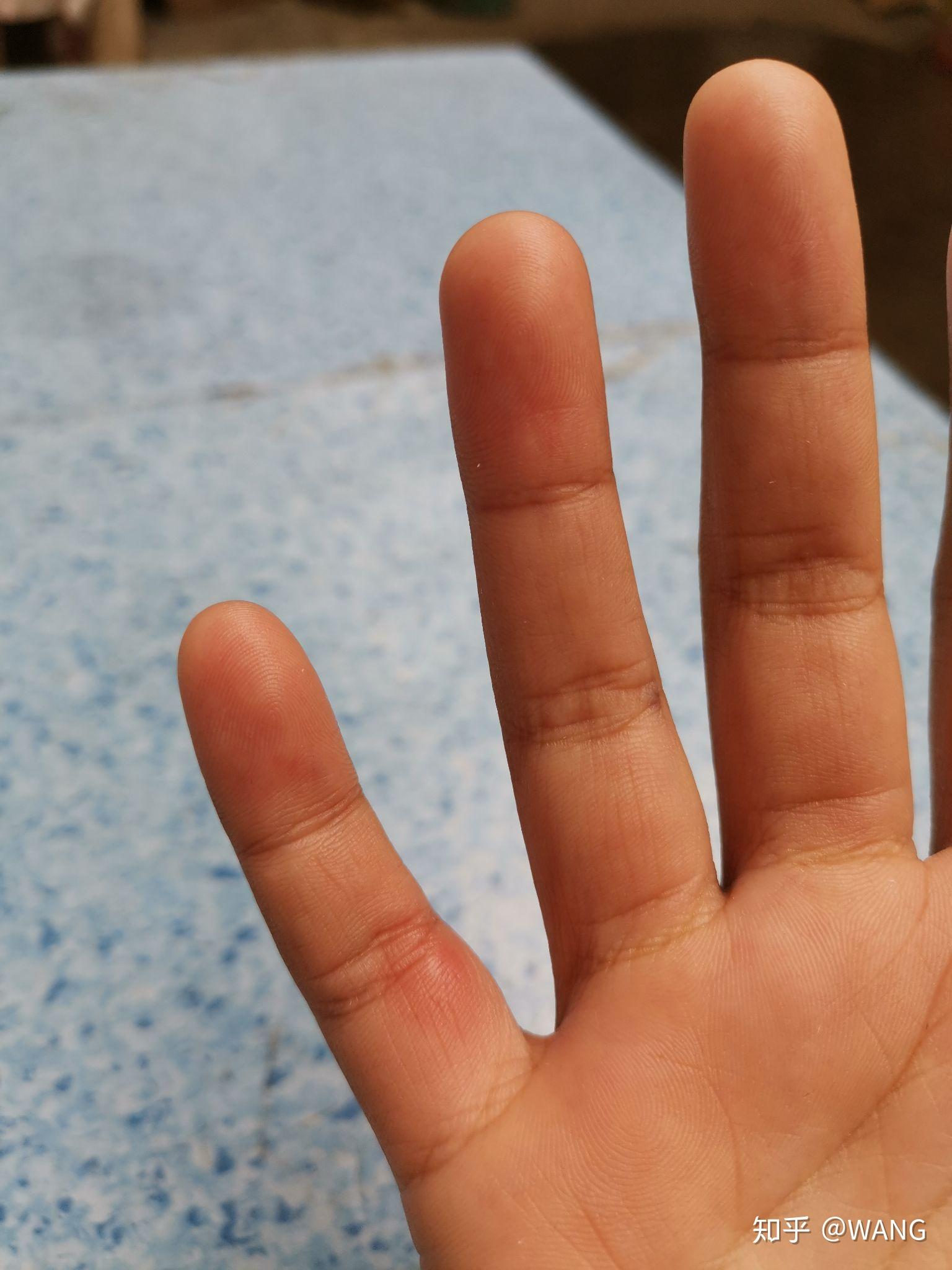 求助：手上的是汗苞疹吗 - 知乎