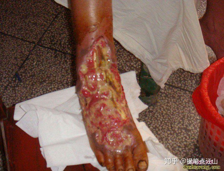 五步蛇名字由何而来,被咬了后真的只能走五步吗～? - 知乎