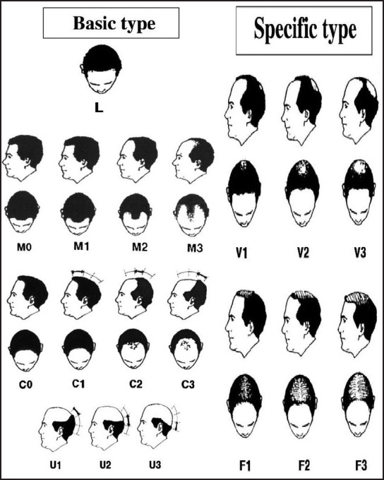 都无法完全详尽的准确无误的去描述和囊括各种各样的脱发等级和类型