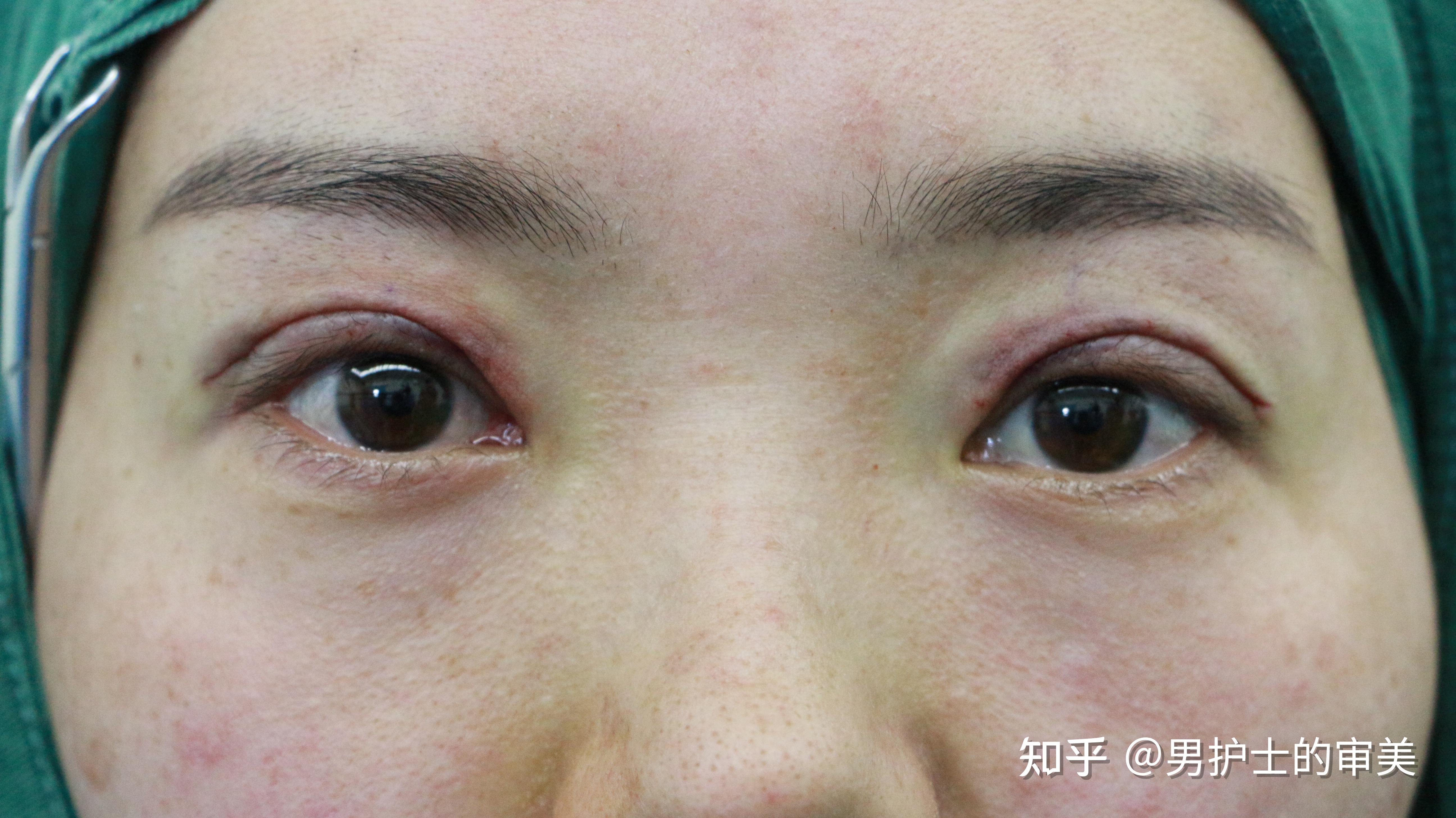 12mm宽平行双眼皮修复开扇形术后17天眼睛变化