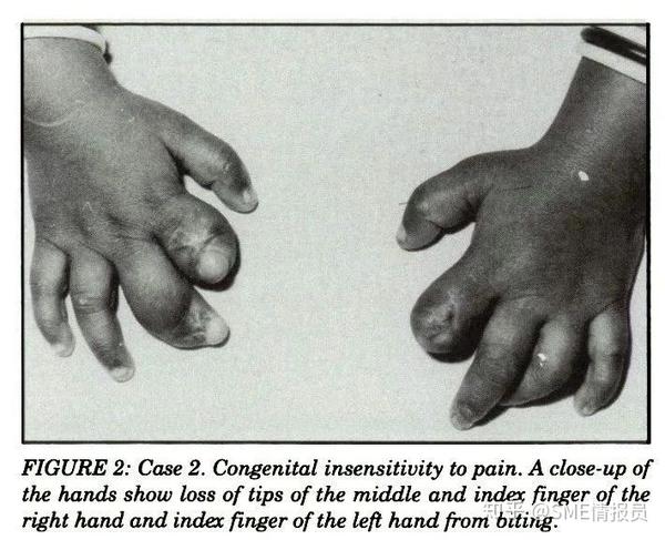 没有疼痛的世界真的是幸福的吗