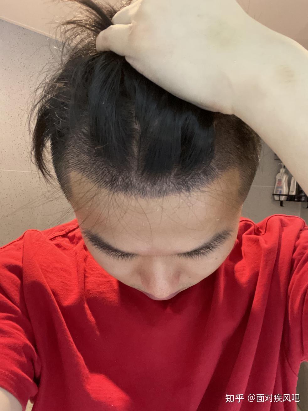 非植发戴发(植发不用自己的头发可以吗)