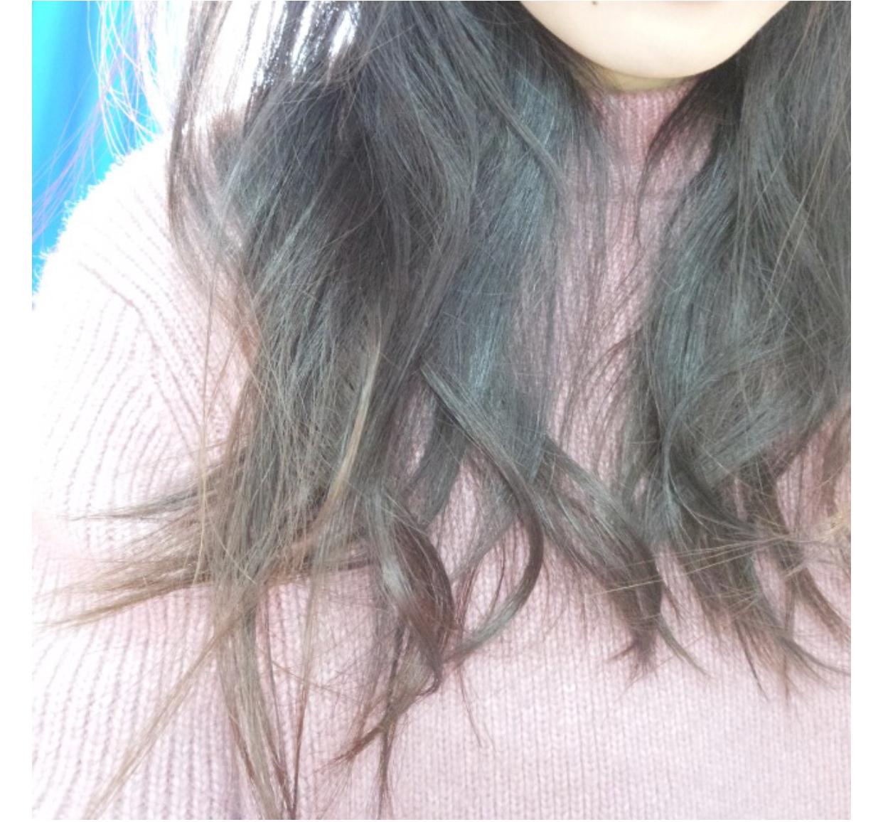 20多岁的女性脱发该如何治疗?