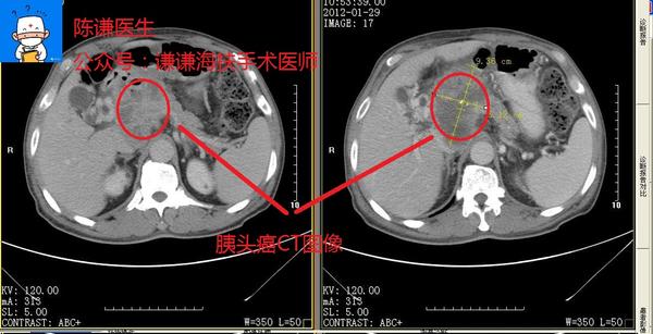 胰腺癌科普之胰腺癌分类 - 知乎