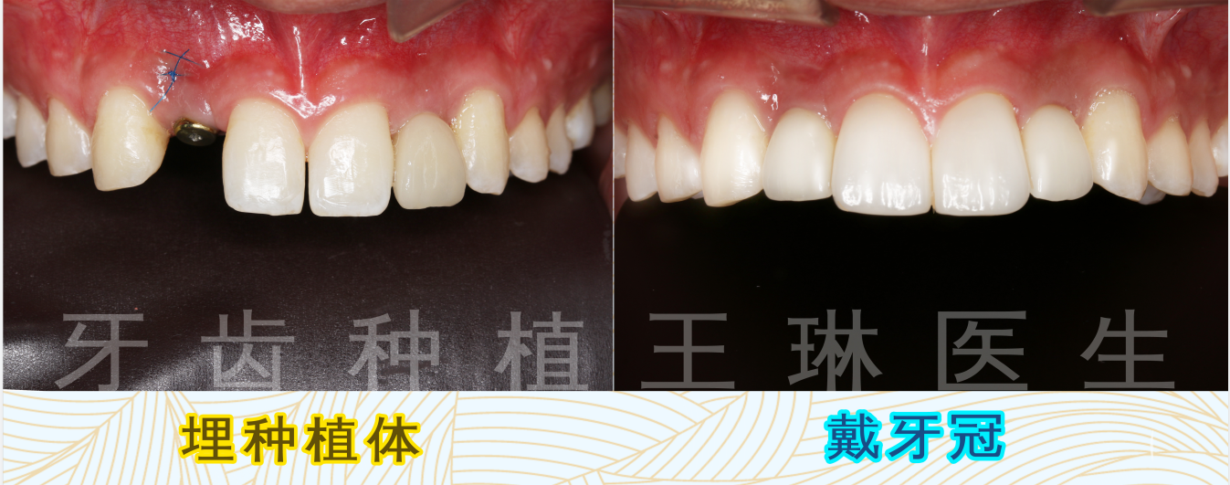 种植牙瑞典诺贝尔品牌15000价格贵吗