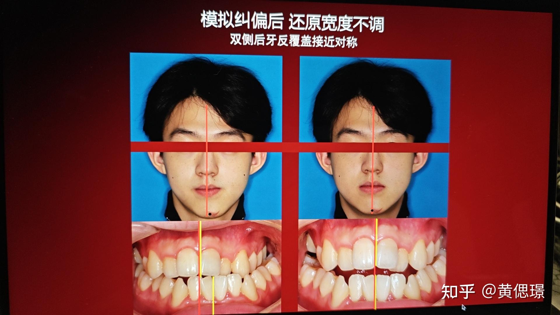 如何确定是否偏颌,以及偏颌的性质? - 知乎